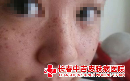 雀斑应该怎么进行预防