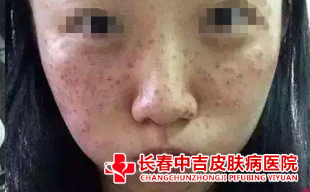 治疗雀斑需要花多少钱