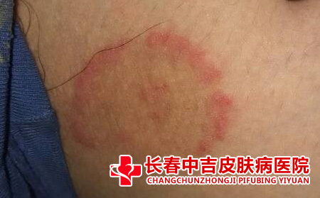 发生过敏的时候应该怎么办
