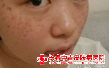 雀斑应该怎么进行治疗