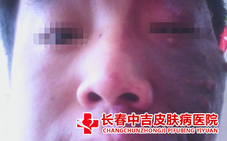 胎记是如何形成的