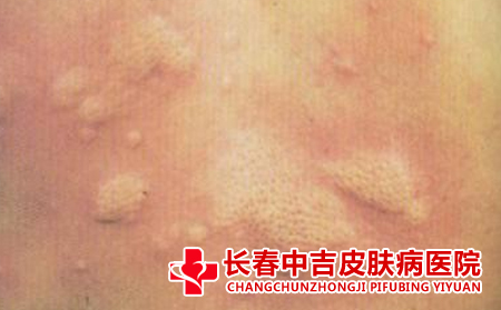 荨麻疹预防措施