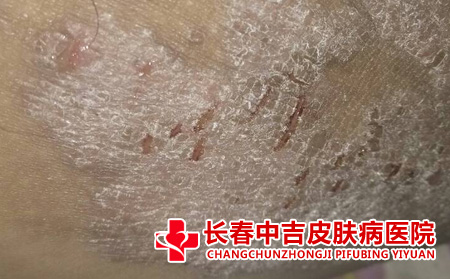 皮肤瘙痒如何解决