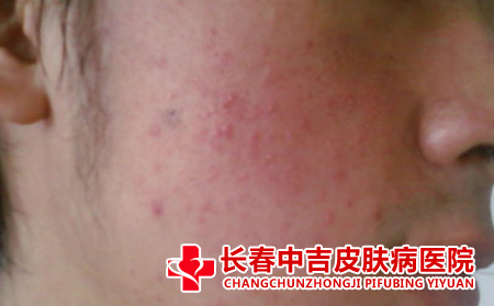  起痤疮的原因是什么