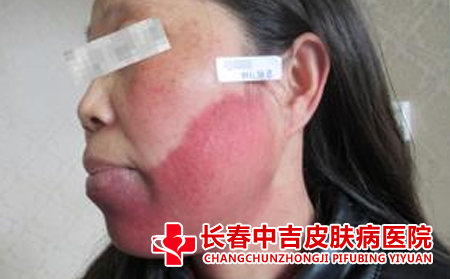 胎记与微量元素有关吗