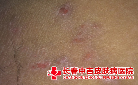 皮肤瘙痒应对措施