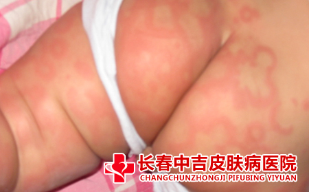  皮肤病瘙痒问题怎么办