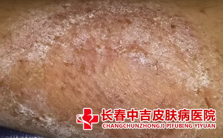  如何应对老年肌肤瘙痒