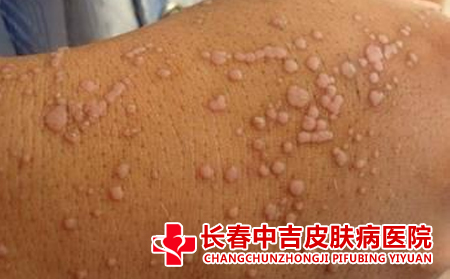 扁平疣症状