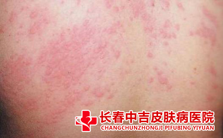 荨麻疹护理