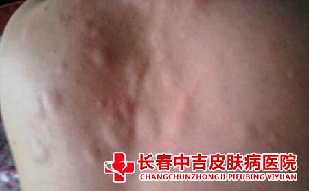 荨麻疹症状