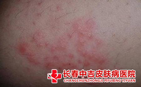 皮肤过敏