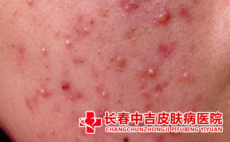 痤疮肌肤