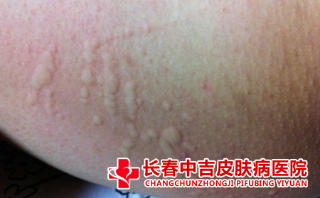 过敏瘙痒