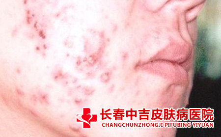 痘痘的护理