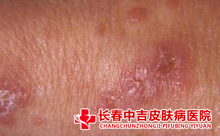 皮肤瘙痒
