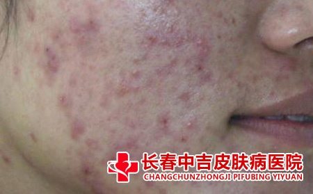 长春痤疮治疗哪里不错