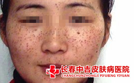 长春治疗雀斑的医院
