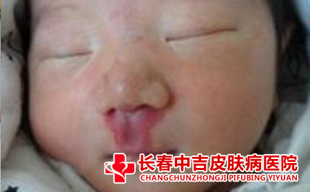 长春哪里能看胎记