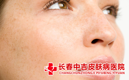 长春哪里能看雀斑