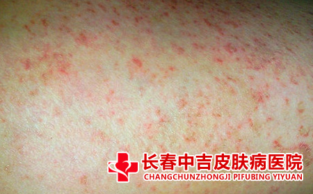 长春哪里能治皮肤瘙痒