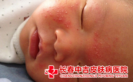 长春哪里能治过敏
