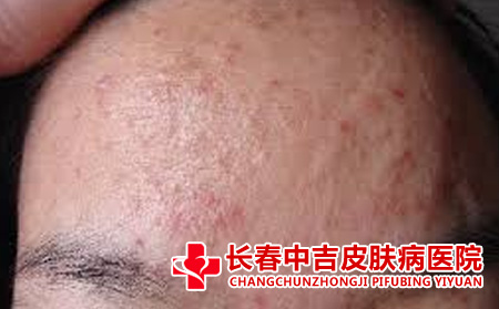 长春治疗长春哪里不错