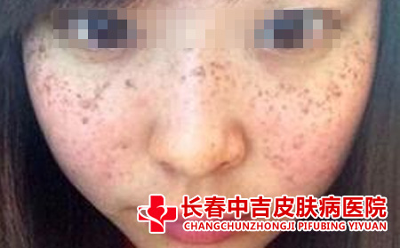 长春哪里能治雀斑