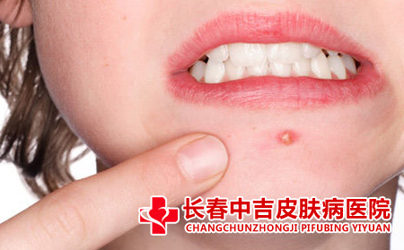 长春哪里能治痤疮