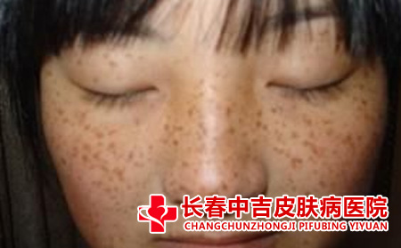 长春治疗雀斑选哪家医院