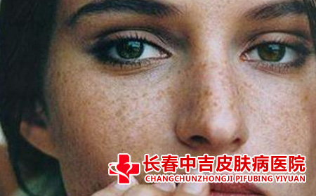 雀斑的危害是什么