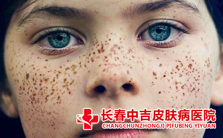 雀斑有哪些危害
