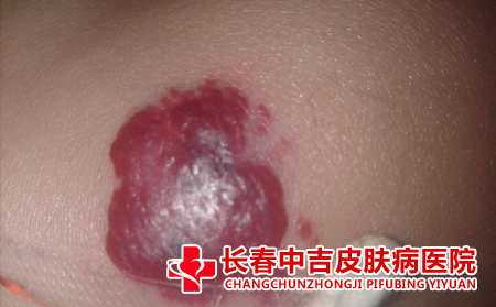 长春治疗胎记专科医院