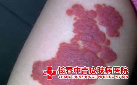 长春去胎记医院选哪家