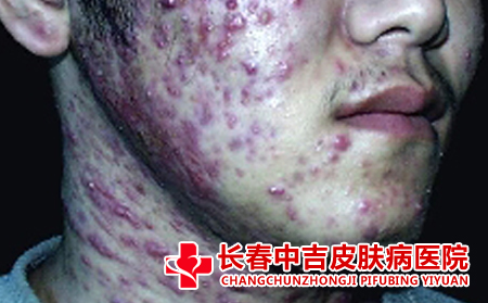 长春哪里能治痤疮