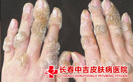 长春治疗扁平疣的医院有哪些