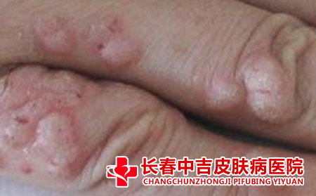 长春治疗扁平疣哪里不错