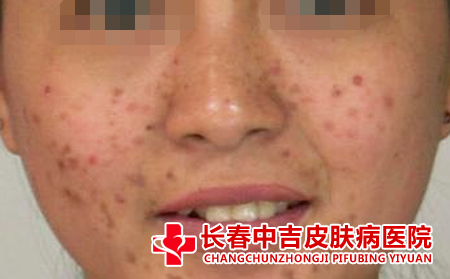 长春哪里治疗雀斑