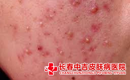 长春哪里治疗痤疮