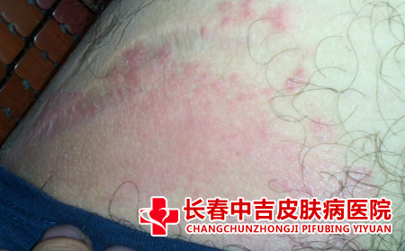 长春哪里治疗皮肤瘙痒