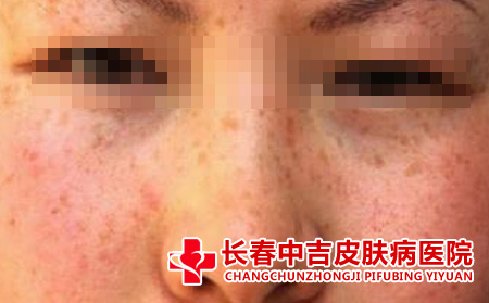 长春哪里治雀斑
