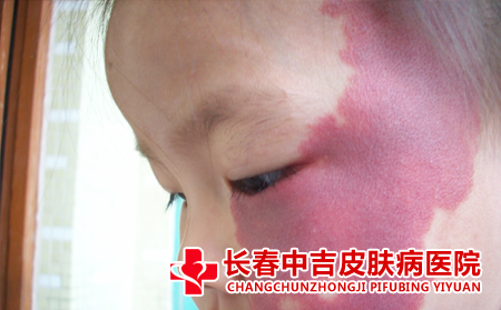 长春胎记怎么办