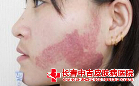 长春哪里治疗胎记