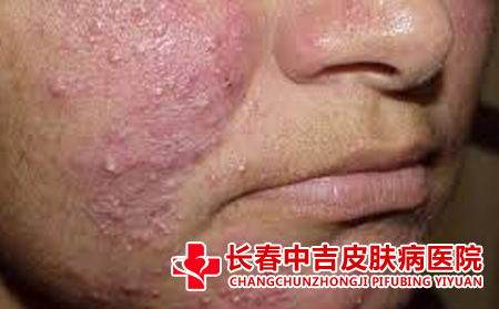 长春哪里治痤疮比较不错
