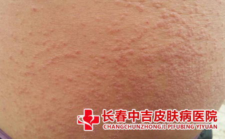 长春哪里治疗皮肤瘙痒合适