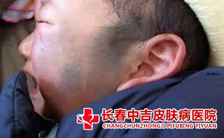 长春哪里治疗太田痣