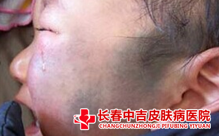 长春哪里治疗太田痣