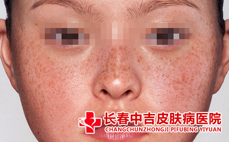 长春治疗雀斑去哪里