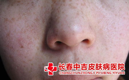 长春哪里合适治疗雀斑