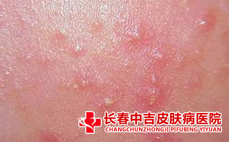 长春哪里治疗痤疮